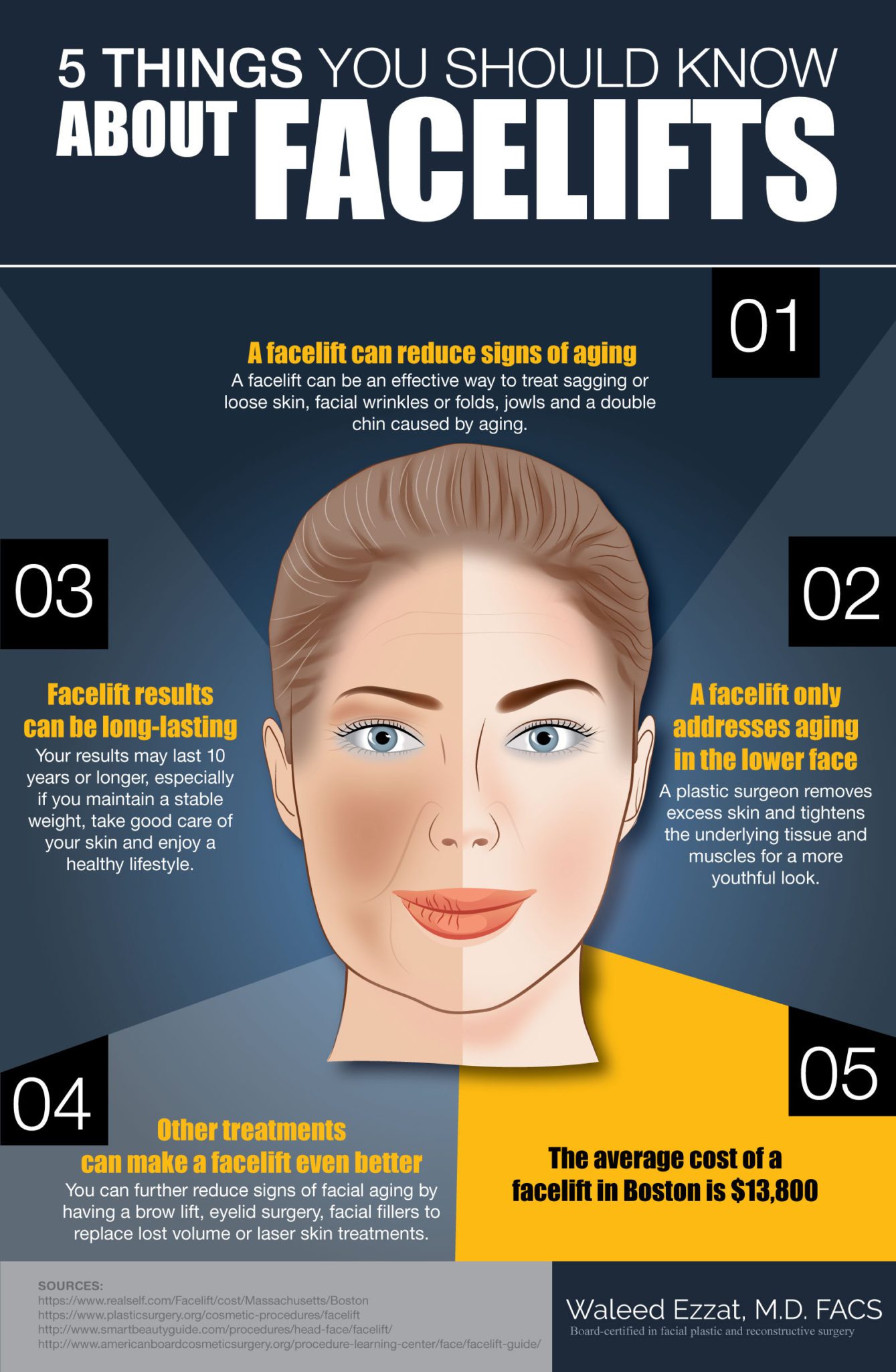 5 Things You Should Know about Facelifts