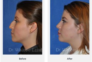 Dr. Ezzat Rhinoplasty Before & After