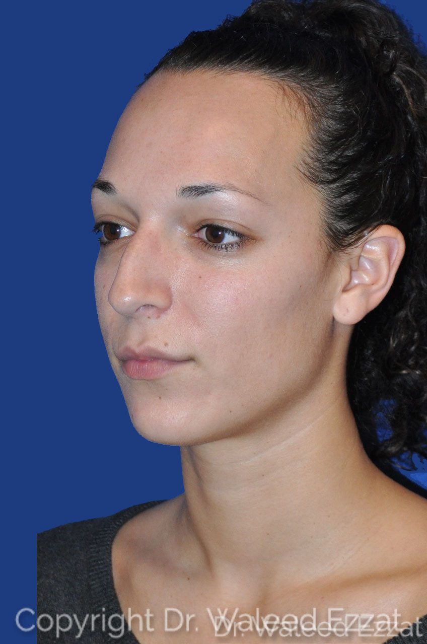 Mediterranean/Middle Eastern Rhinoplasty Patient Photo - Case 2 - before view-2