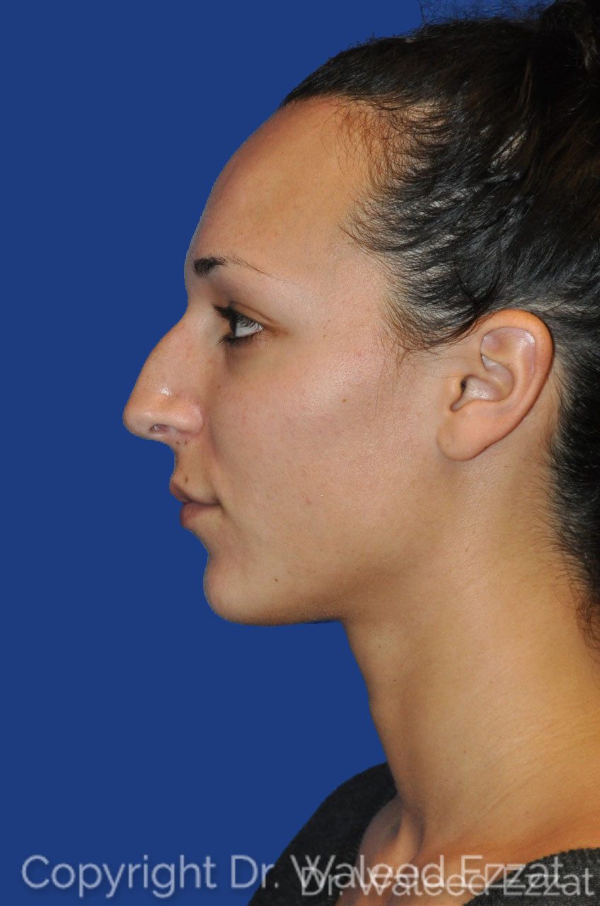Mediterranean/Middle Eastern Rhinoplasty Patient Photo - Case 2 - before view-