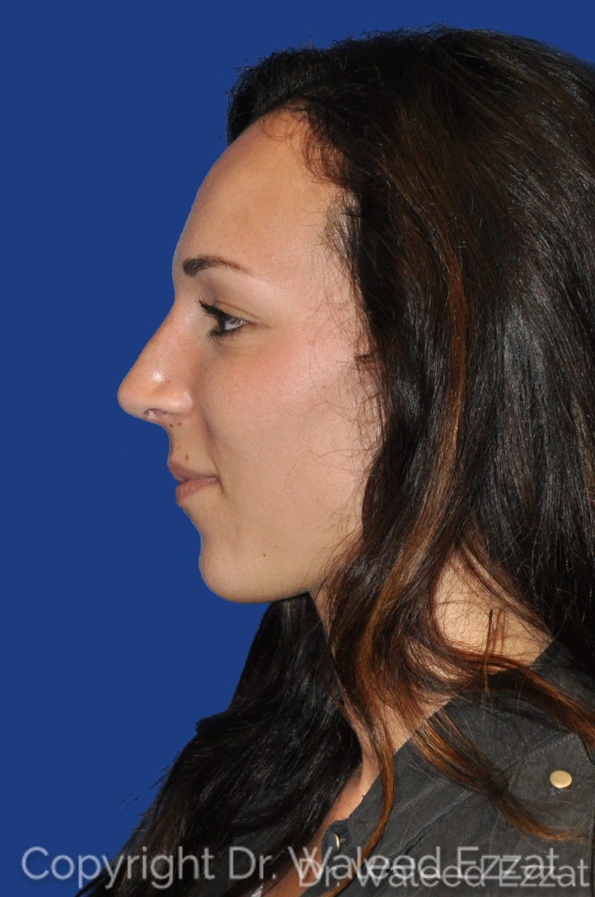 Mediterranean/Middle Eastern Rhinoplasty Patient Photo - Case 2 - after view-0