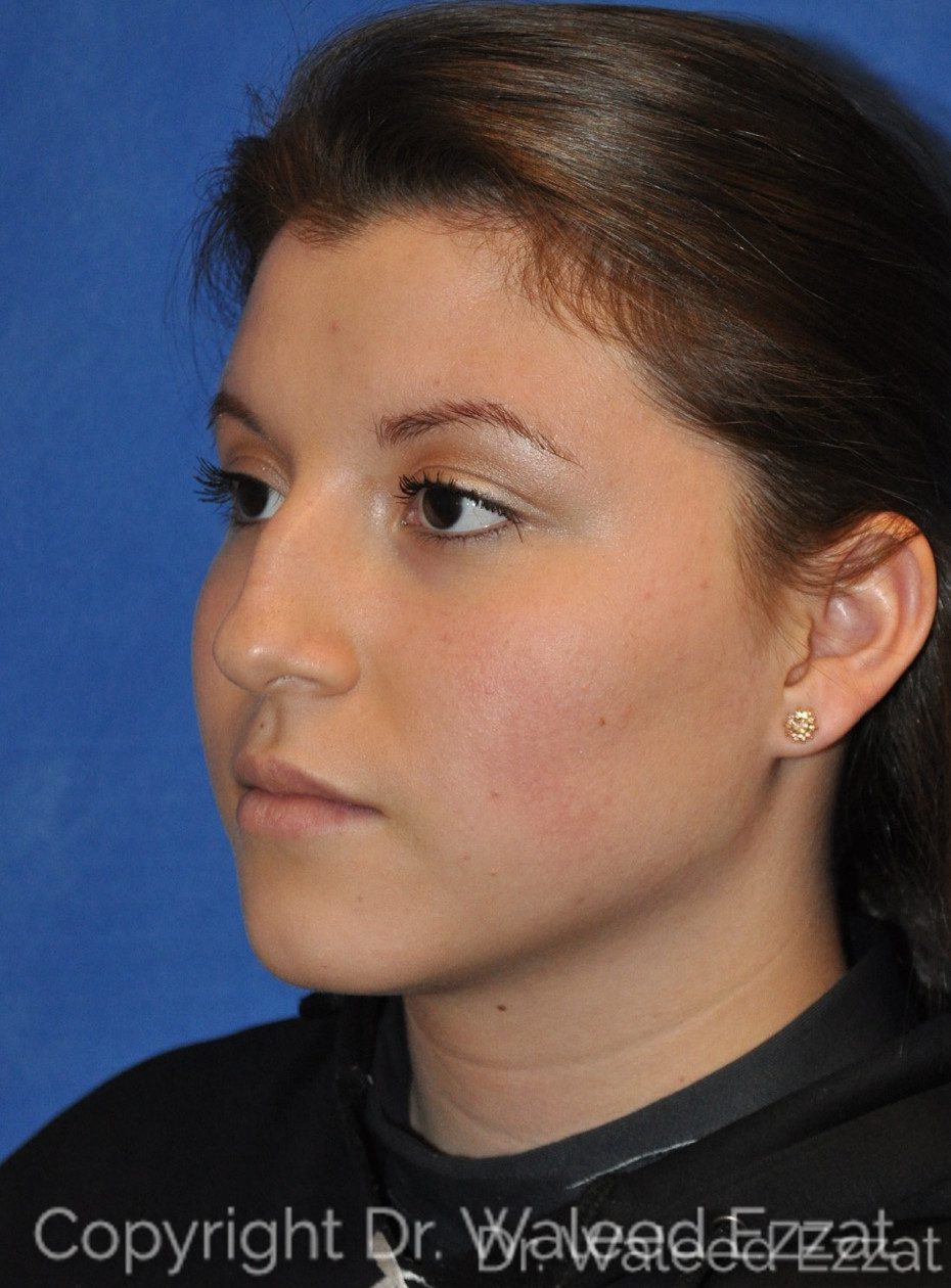 Hispanic/South American Rhinoplasty Patient Photo - Case 5 - before view-1