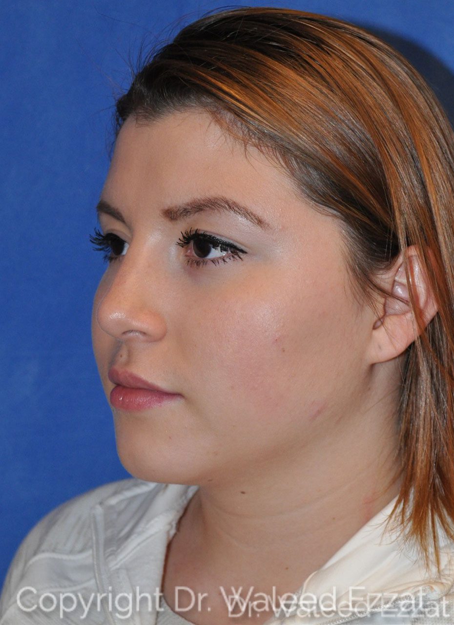 Hispanic/South American Rhinoplasty Patient Photo - Case 5 - after view-1