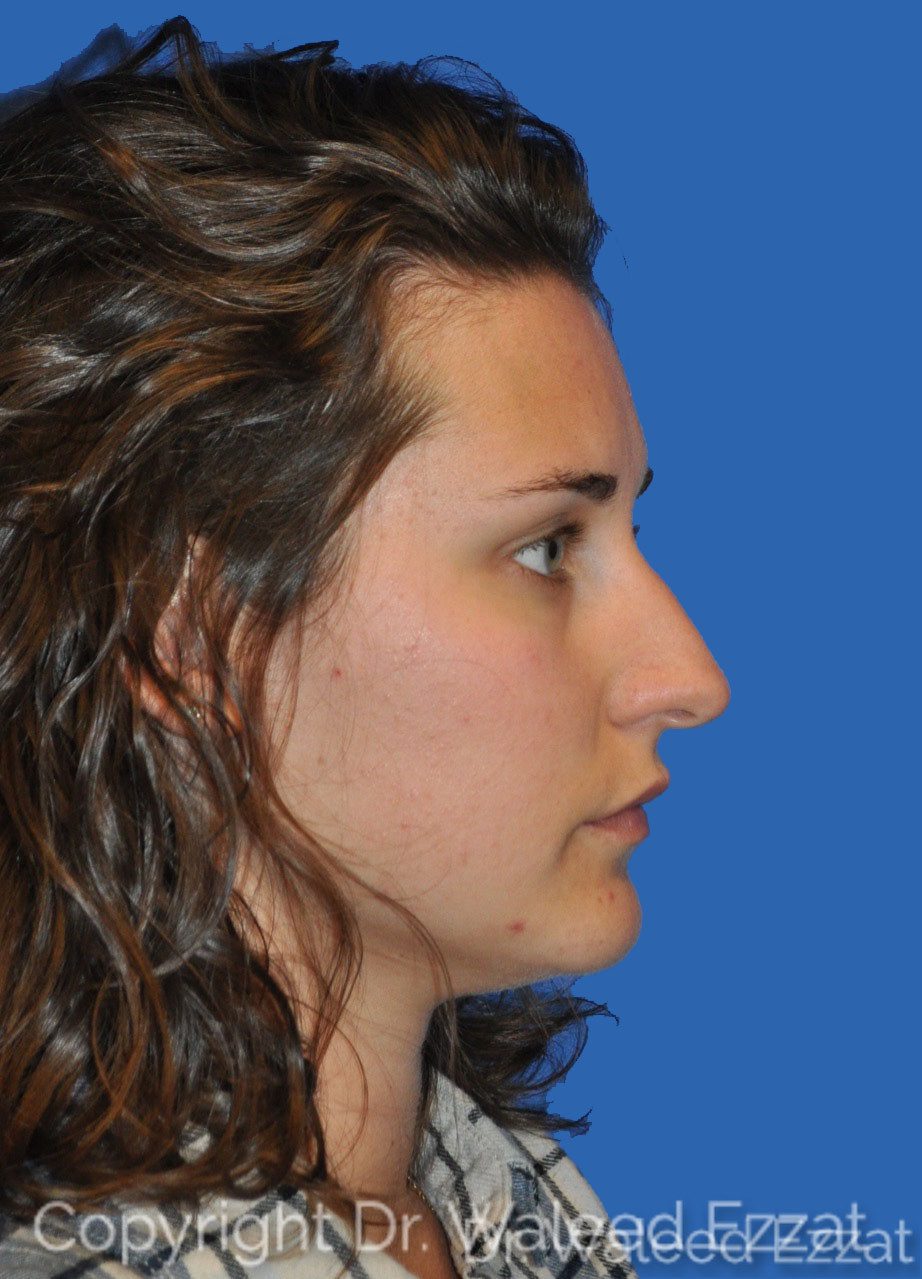 Mediterranean/Middle Eastern Rhinoplasty Patient Photo - Case 7 - before view-