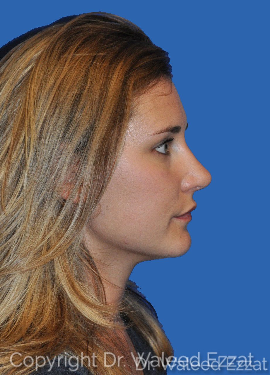 Mediterranean/Middle Eastern Rhinoplasty Patient Photo - Case 7 - after view