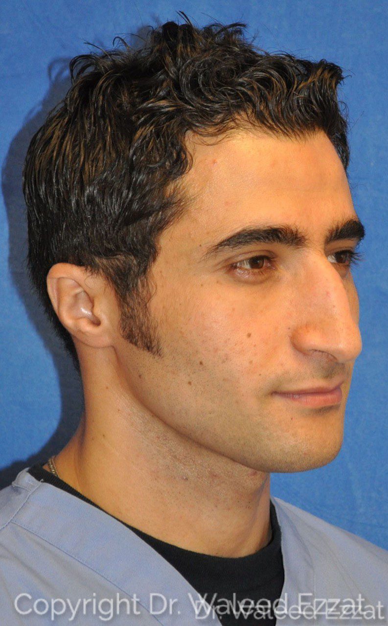 Male Rhinoplasty Patient Photo - Case 26 - before view-2