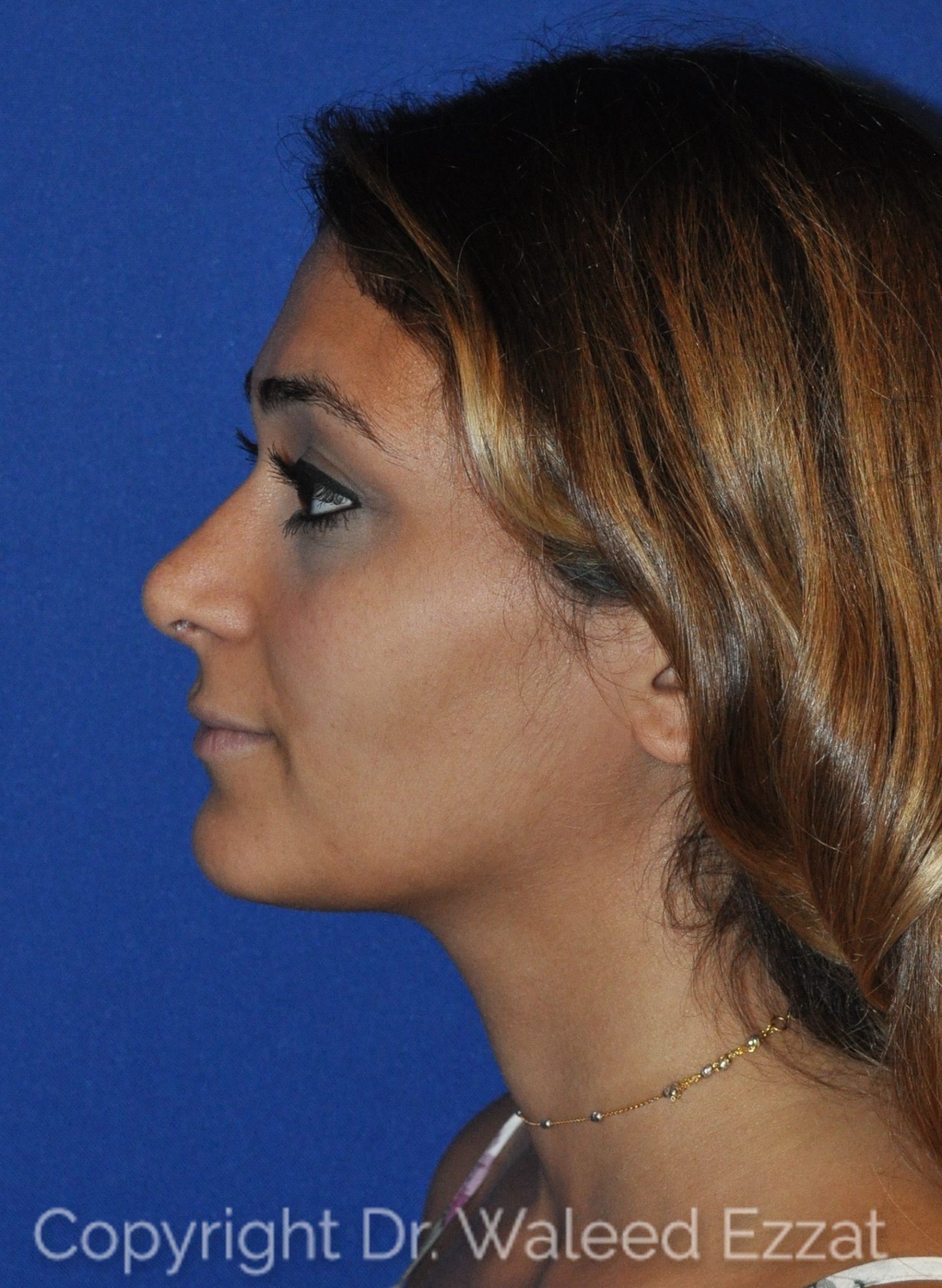 Mediterranean/Middle Eastern Rhinoplasty Patient Photo - Case 9 - after view-0