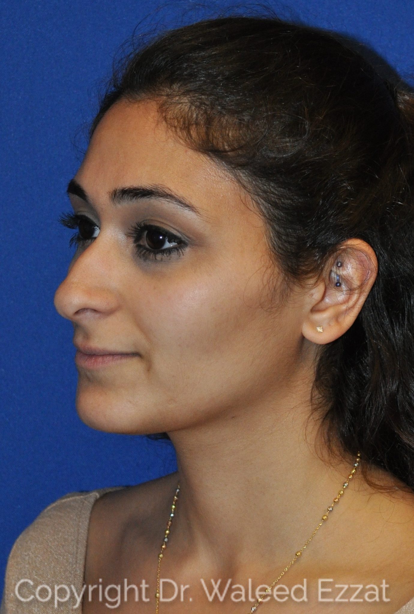 Mediterranean/Middle Eastern Rhinoplasty Patient Photo - Case 9 - before view-1