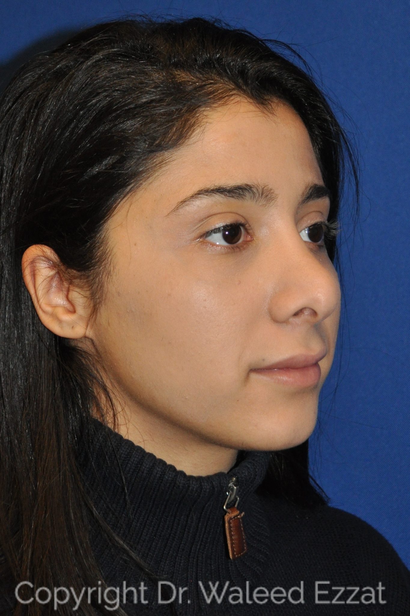 Mediterranean/Middle Eastern Rhinoplasty Patient Photo - Case 104 - before view-1