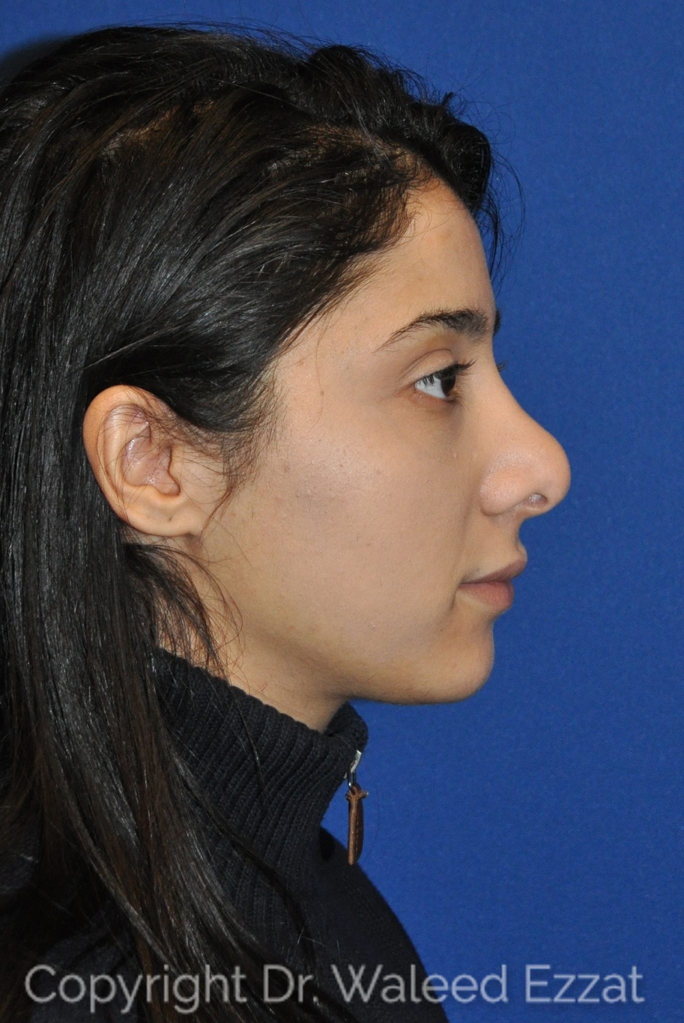 Mediterranean/Middle Eastern Rhinoplasty Patient Photo - Case 104 - before view-