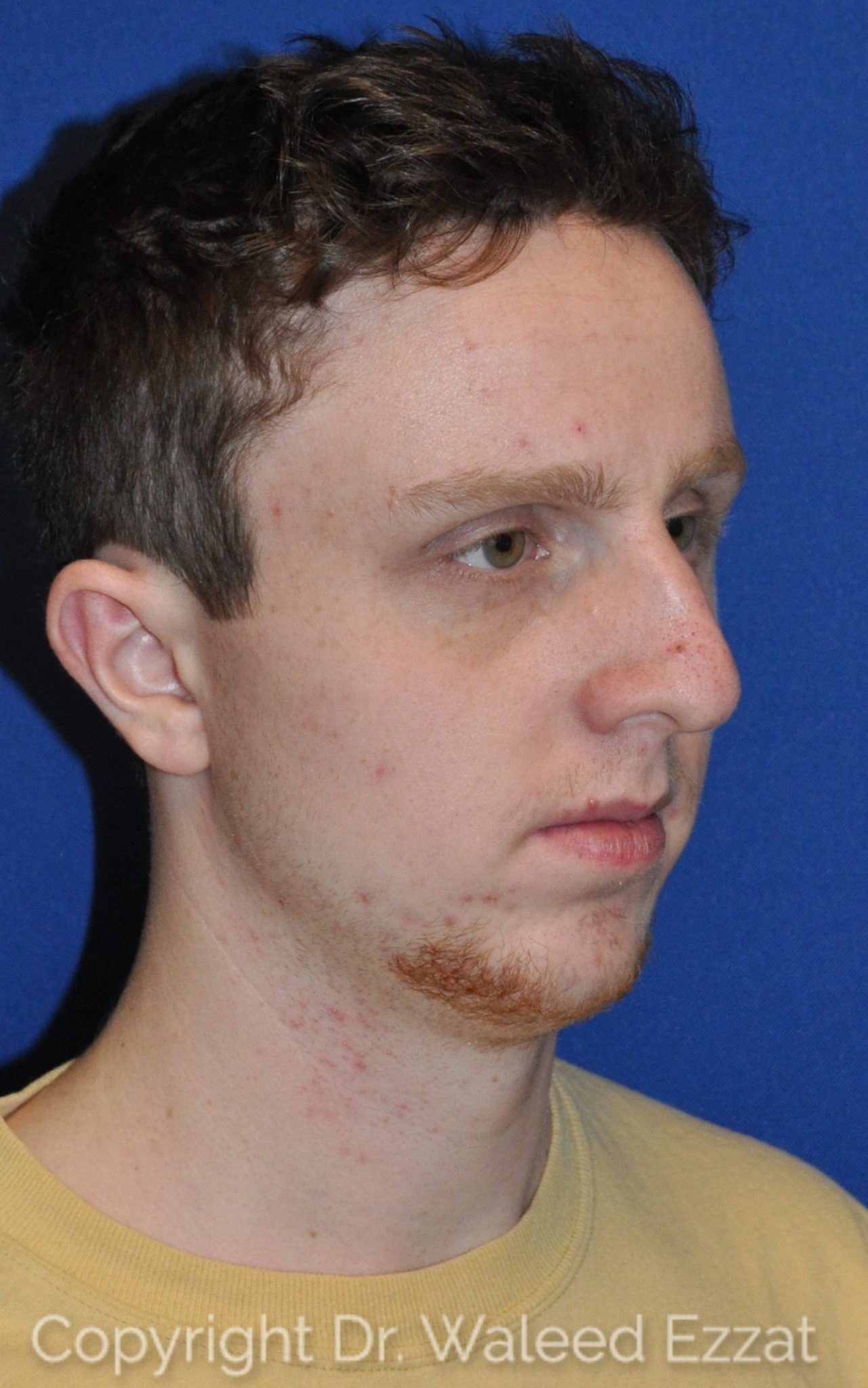 Male Rhinoplasty Patient Photo - Case 24 - before view-