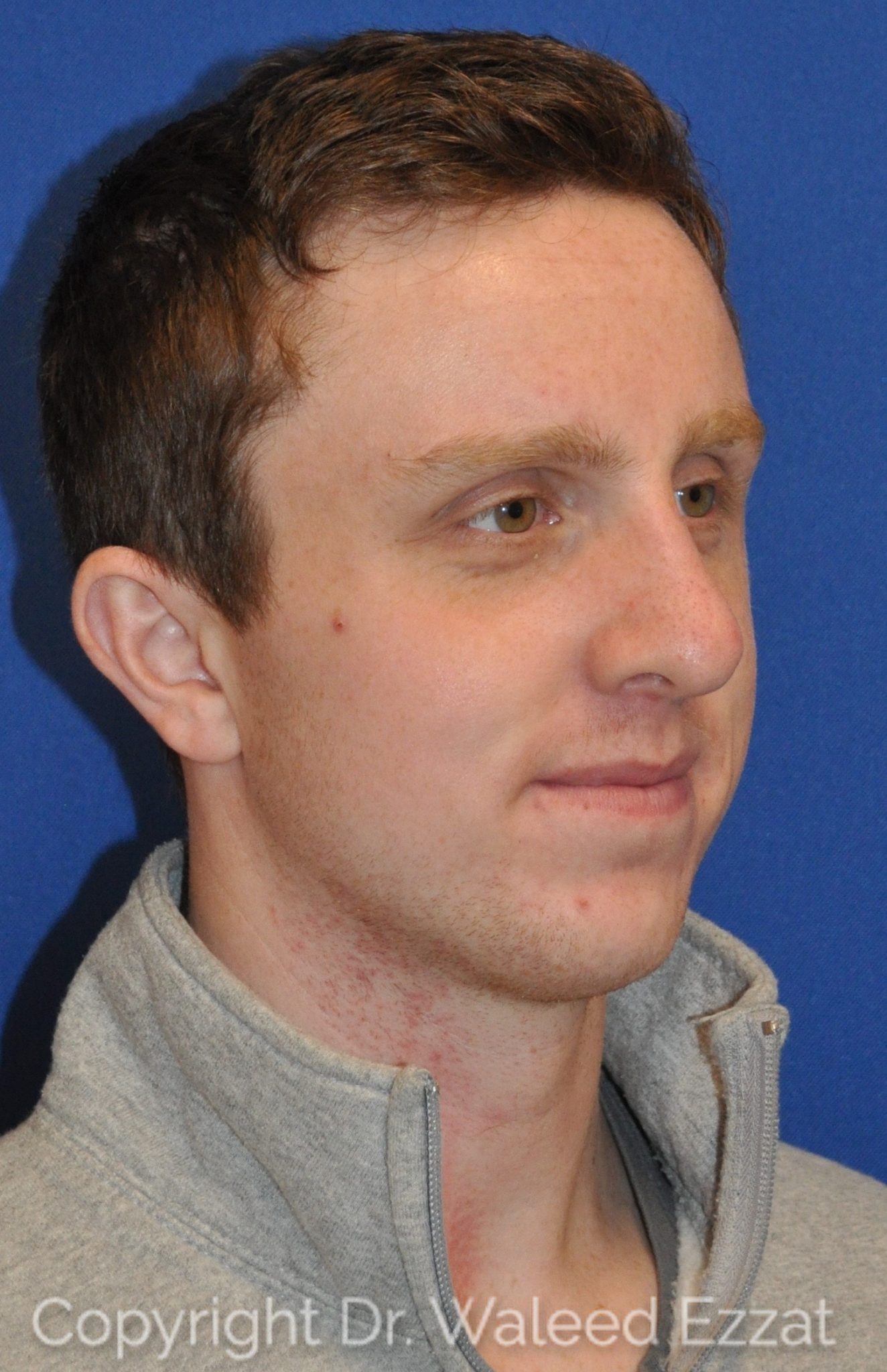 Male Rhinoplasty Patient Photo - Case 24 - after view