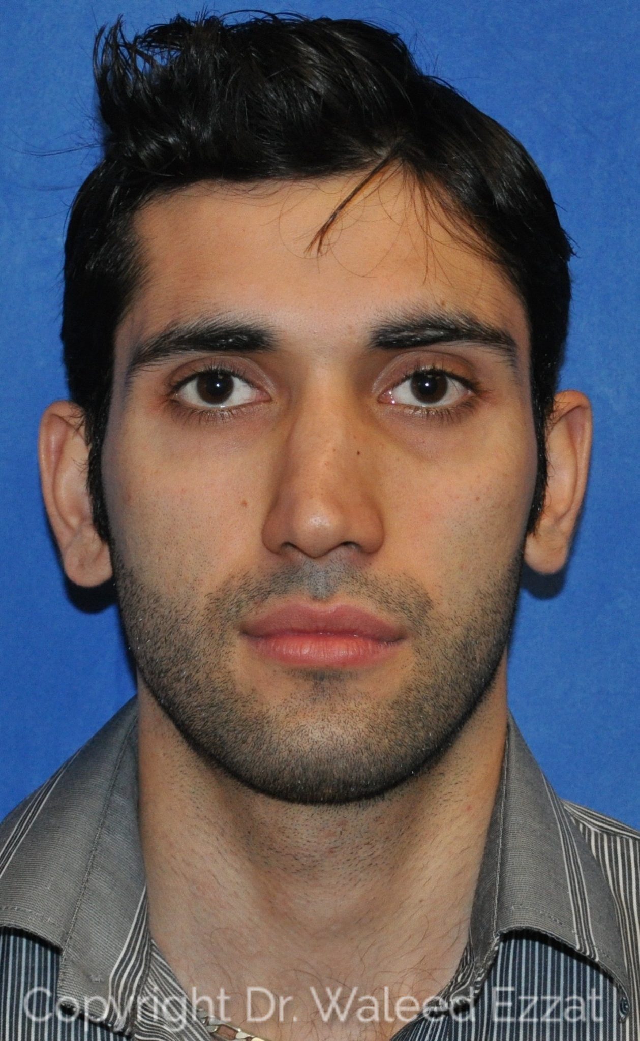 Mediterranean/Middle Eastern Rhinoplasty Patient Photo - Case 14 - before view-1