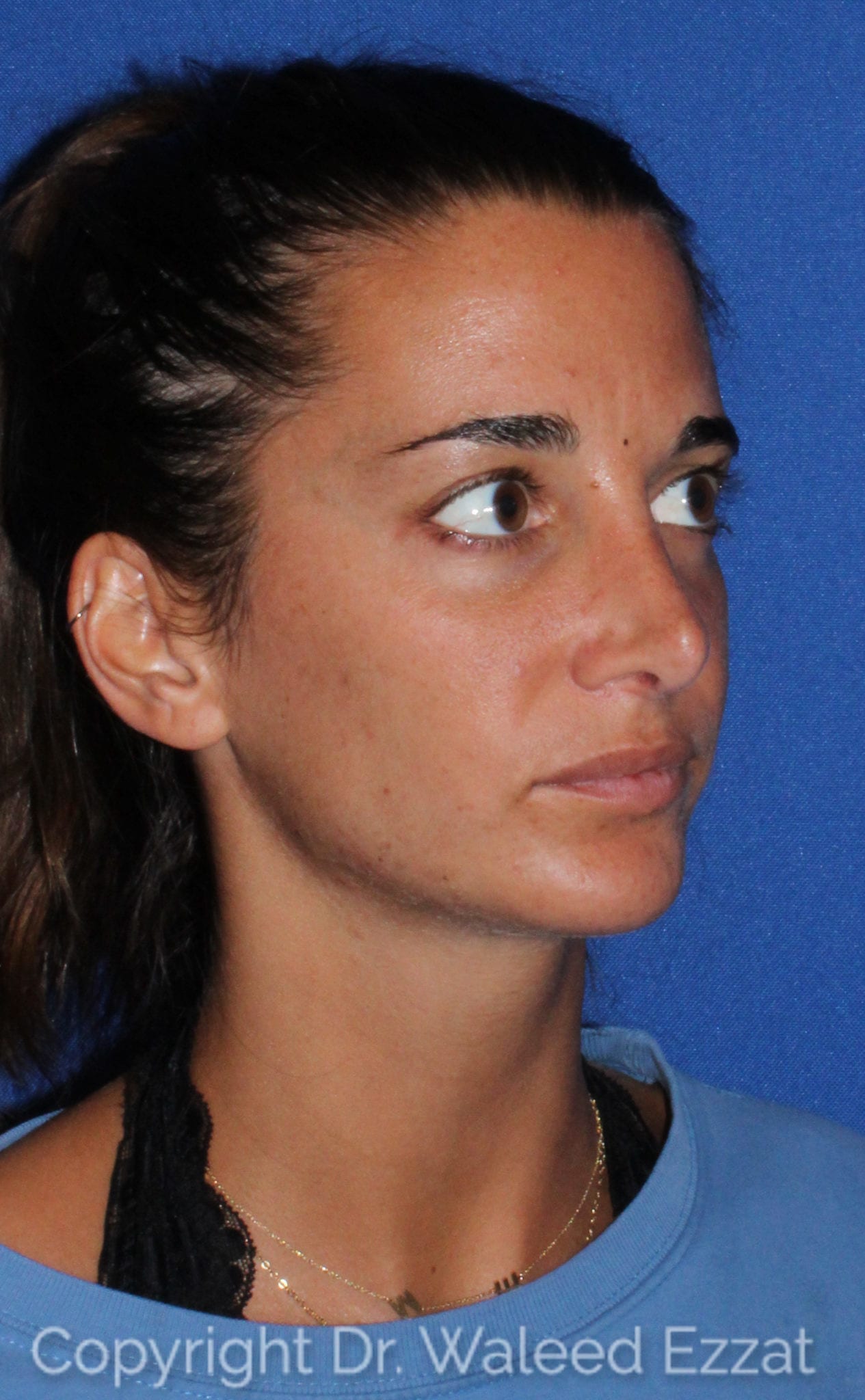 Revision Rhinoplasty Patient Photo - Case 107 - after view-1