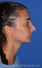 Chin Augmentation - Case 107 - After