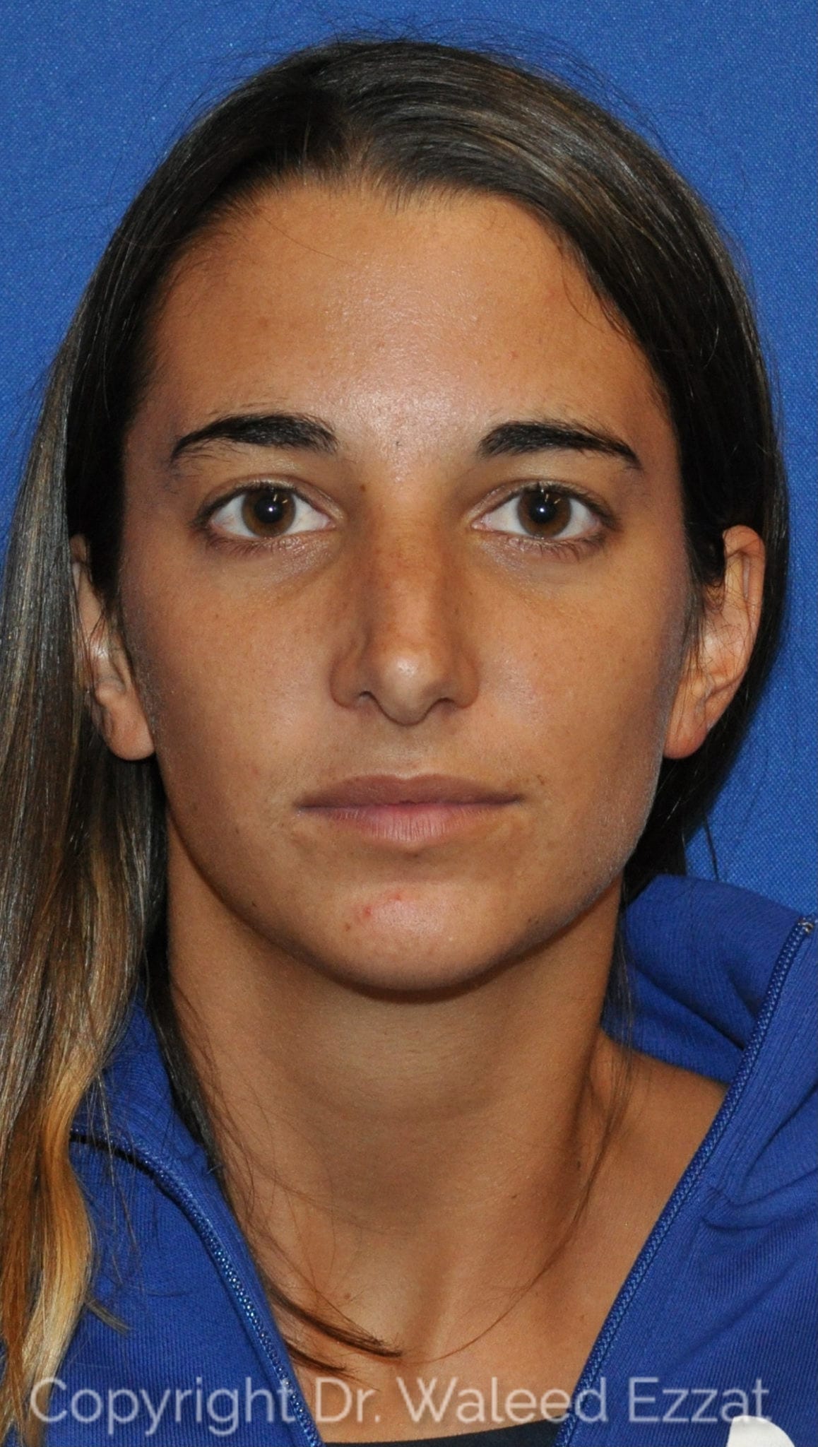 Revision Rhinoplasty Patient Photo - Case 107 - before view-2