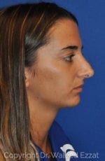 Chin Augmentation - Case 107 - Before
