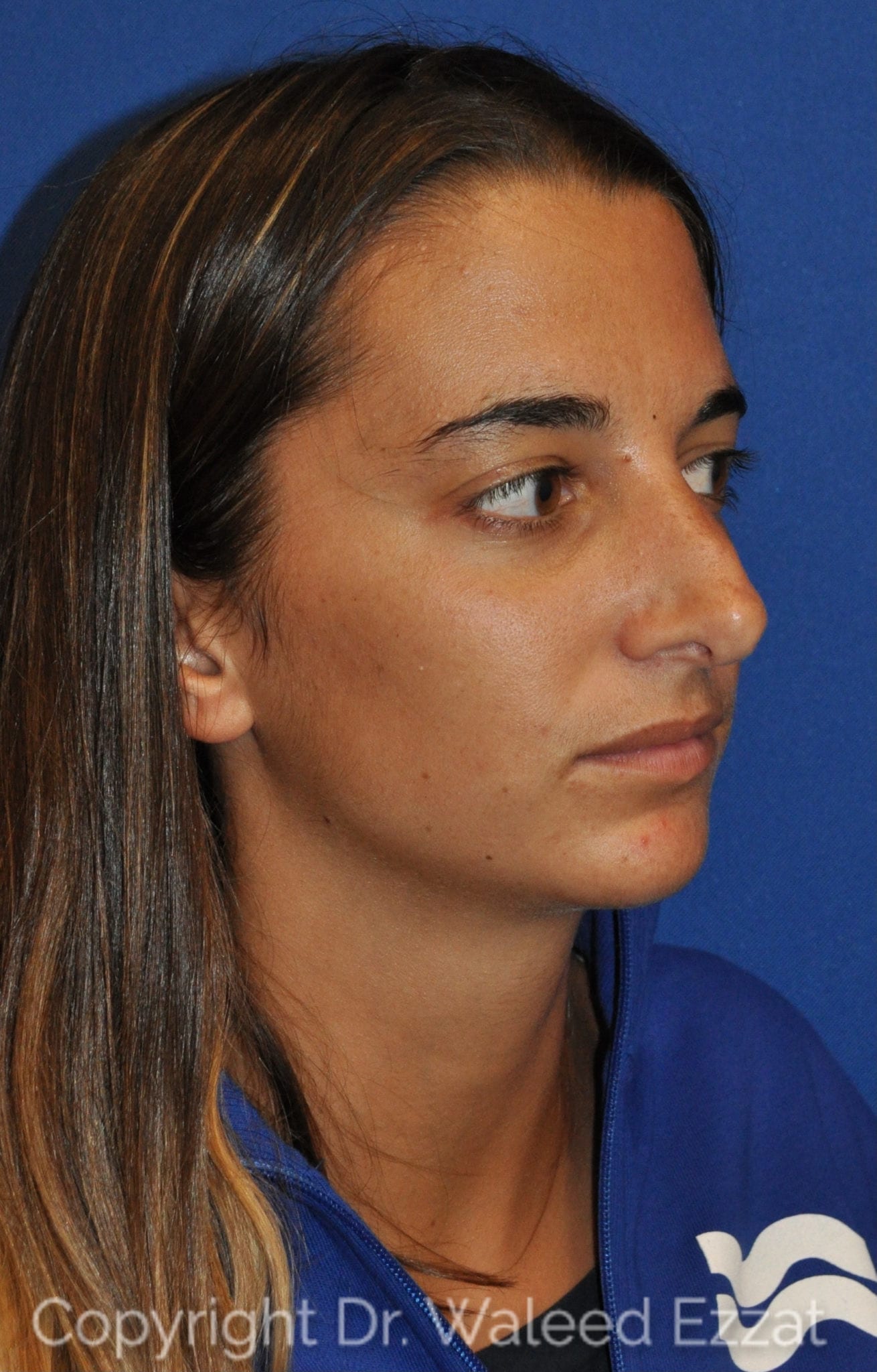 Revision Rhinoplasty Patient Photo - Case 107 - before view-1