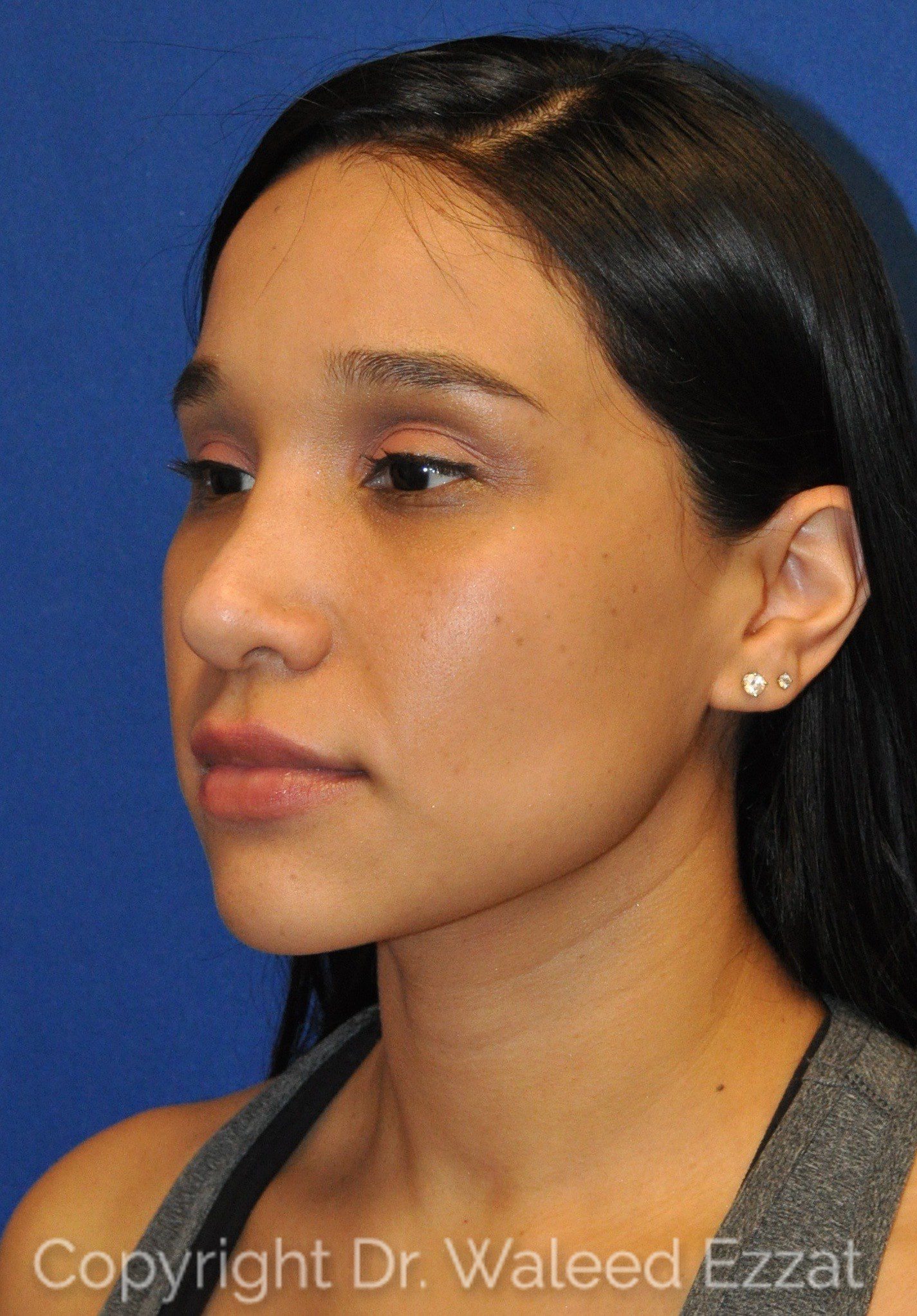 Hispanic/South American Rhinoplasty Patient Photo - Case 108 - before view-1