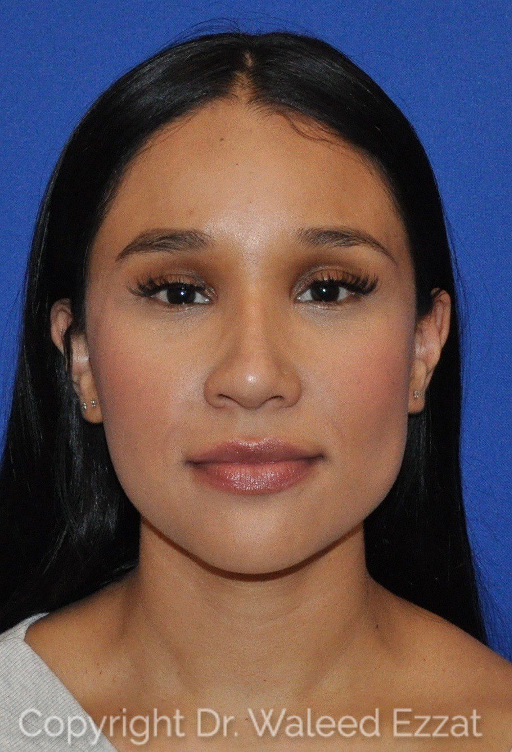 Hispanic/South American Rhinoplasty Patient Photo - Case 108 - after view-2