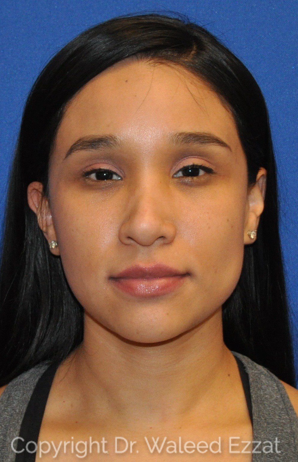 Hispanic/South American Rhinoplasty Patient Photo - Case 108 - before view-2