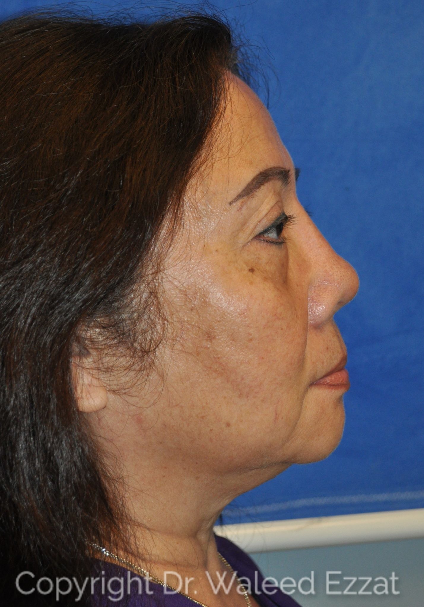 East Asian Rhinoplasty Patient Photo - Case 950 - before view-