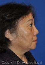 East Asian Rhinoplasty - Case 950 - After