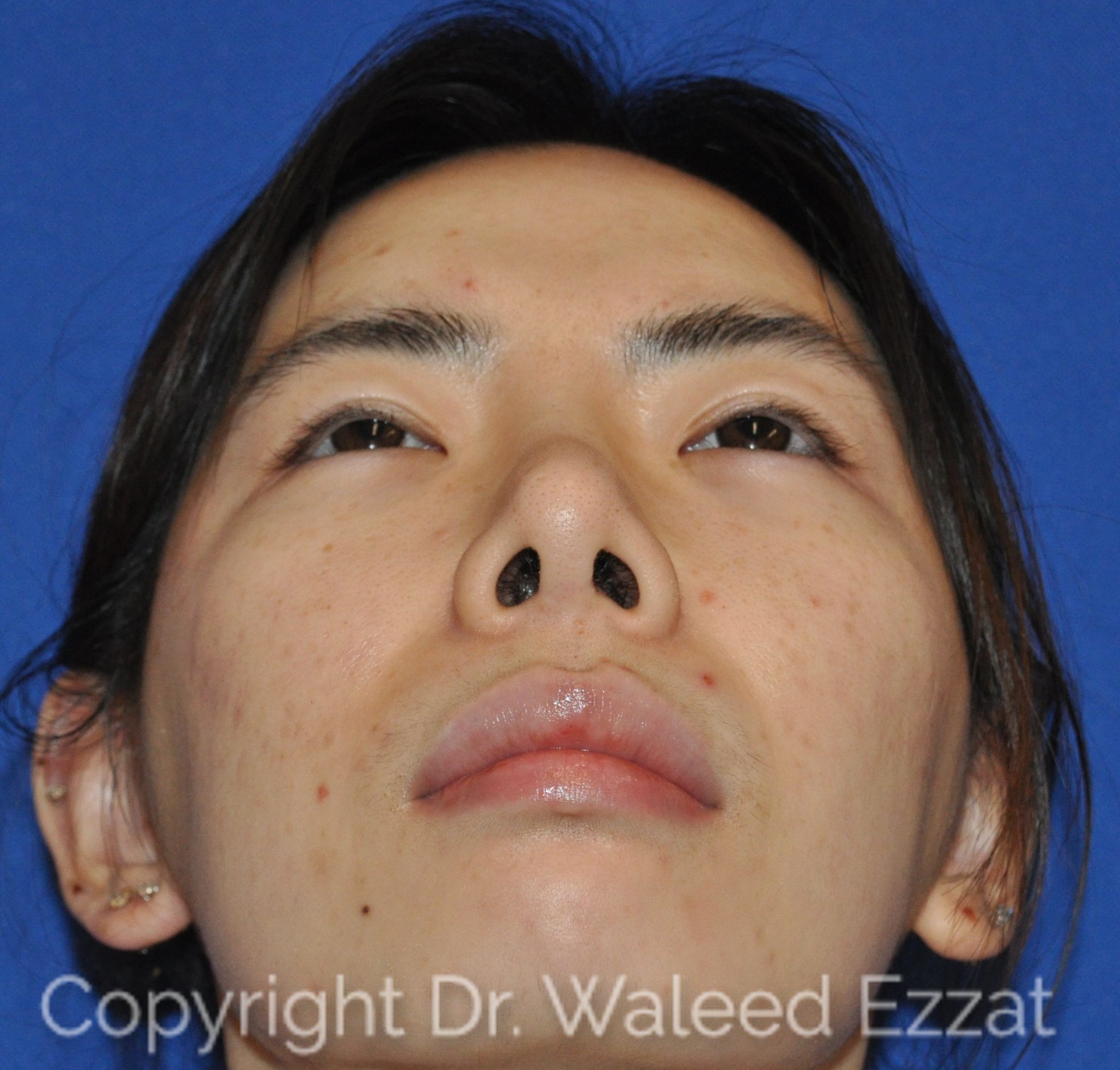 East Asian Rhinoplasty Patient Photo - Case 951 - before view-2