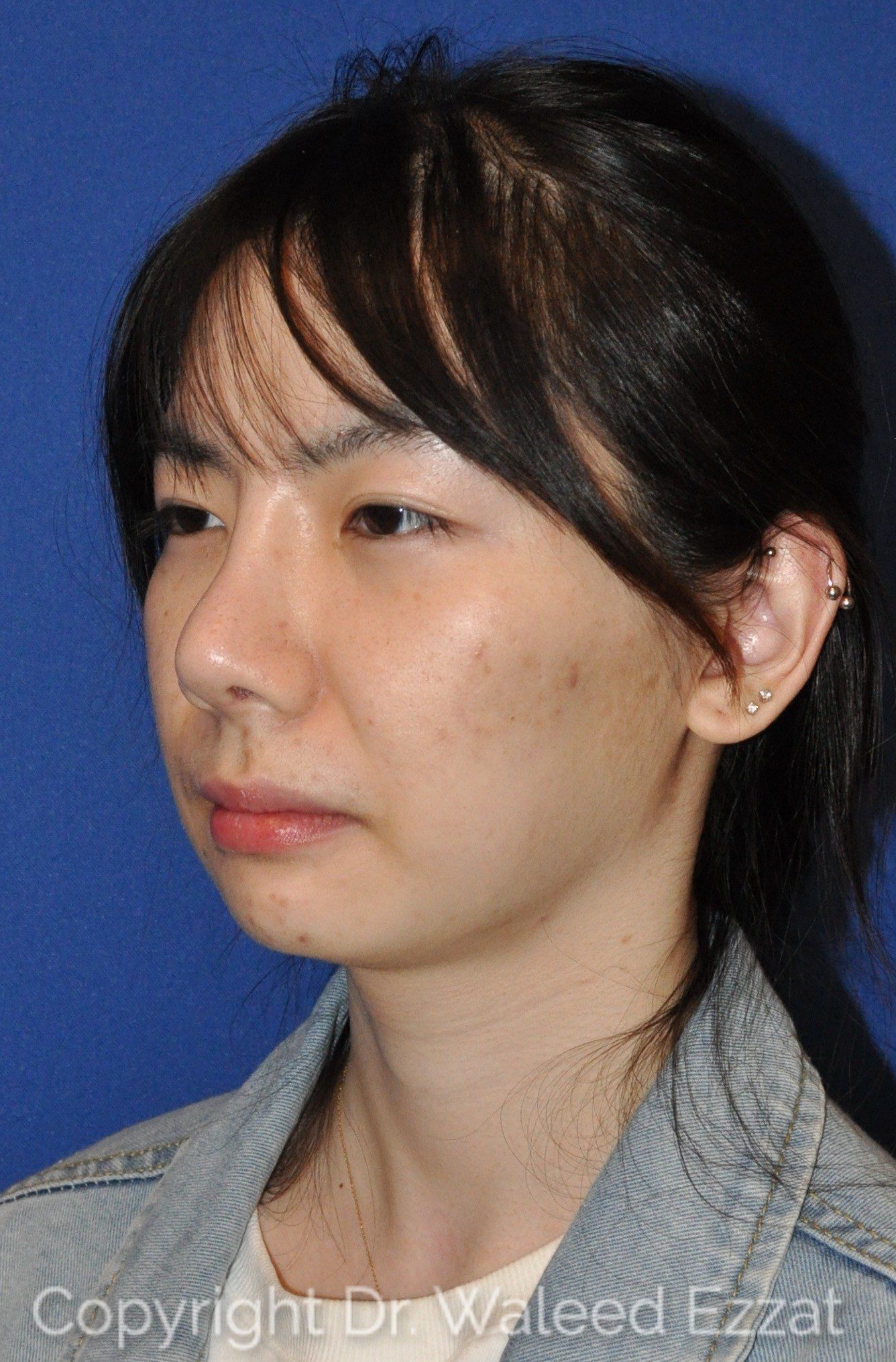 East Asian Rhinoplasty Patient Photo - Case 951 - after view-1
