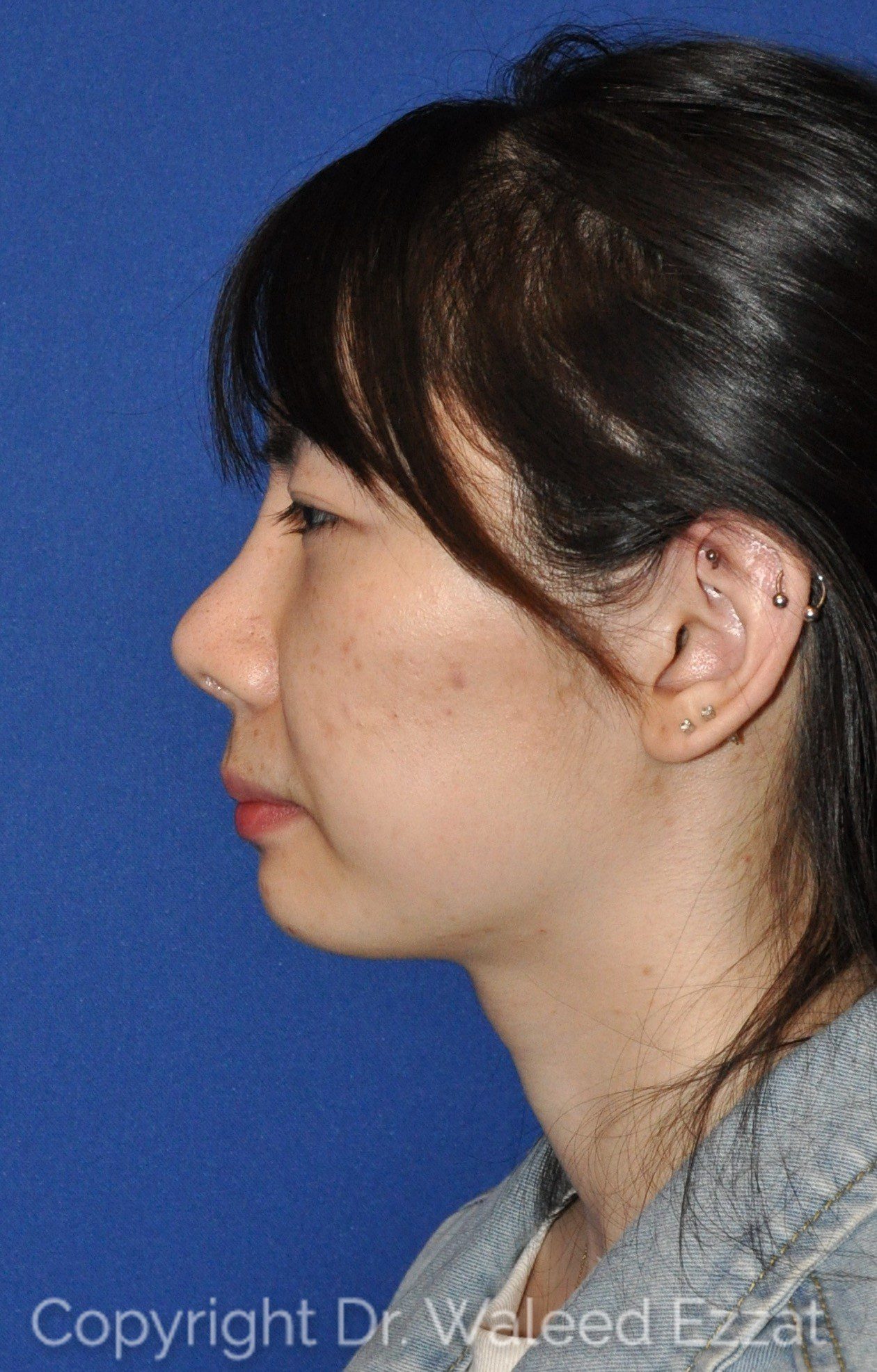 East Asian Rhinoplasty Patient Photo - Case 951 - after view