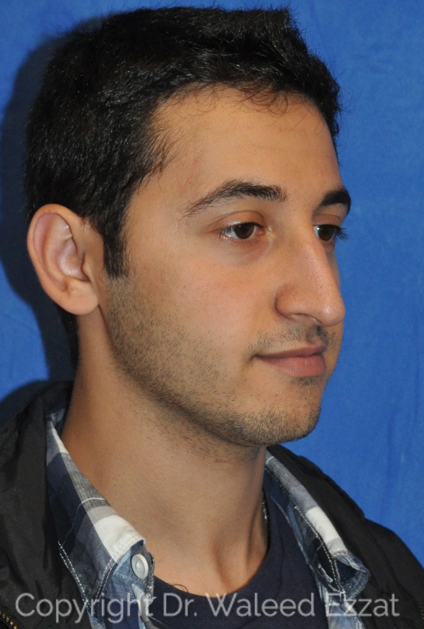 Male Rhinoplasty Patient Photo - Case 28 - before view-1