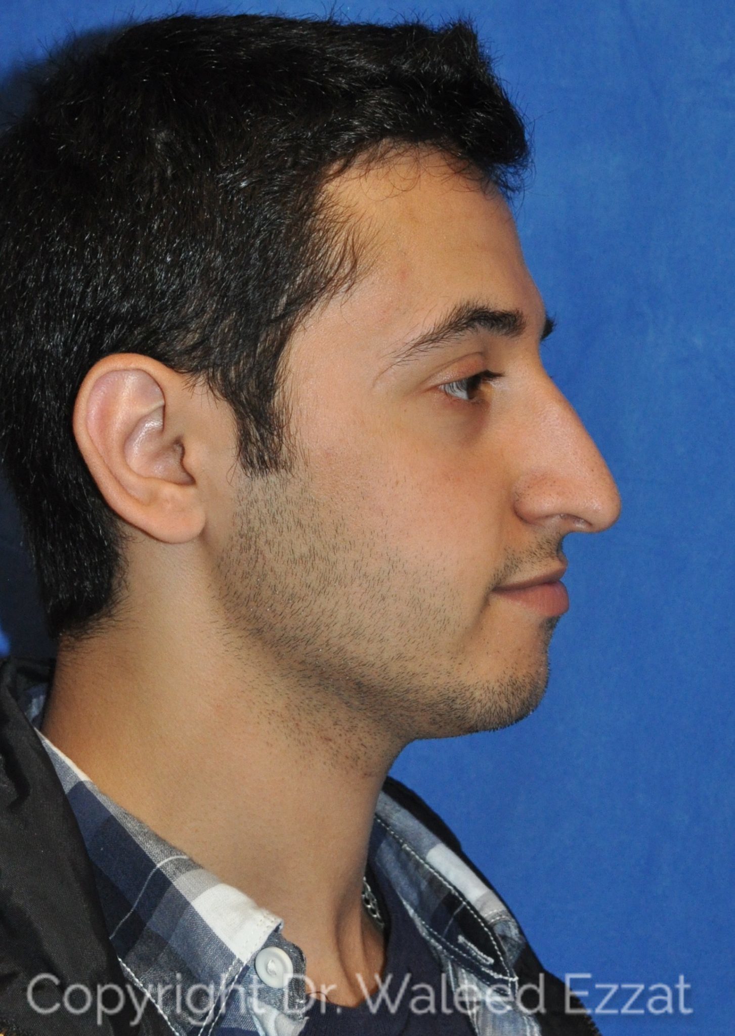 Male Rhinoplasty Patient Photo - Case 28 - before view-