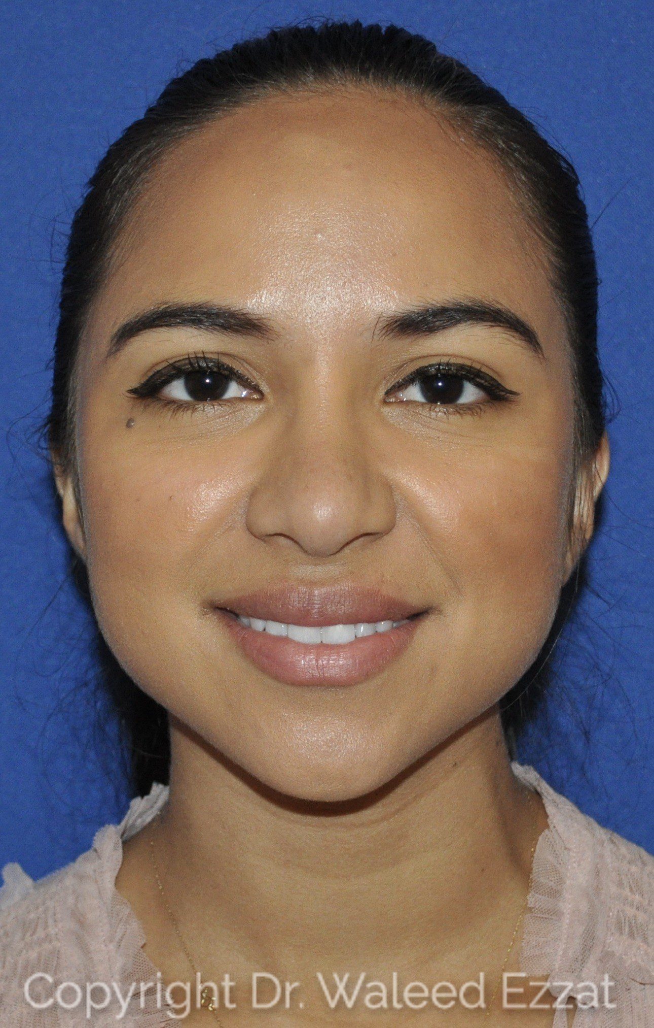 Hispanic/South American Rhinoplasty Patient Photo - Case 21-2 - after view-2