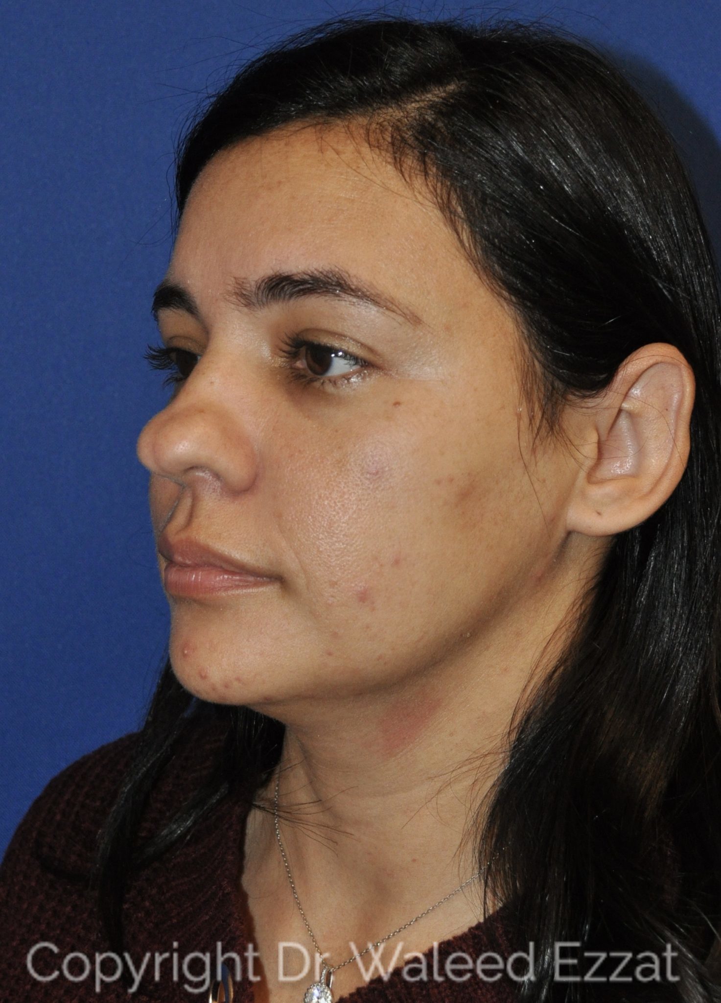 Hispanic/South American Rhinoplasty Patient Photo - Case 22 - before view-2