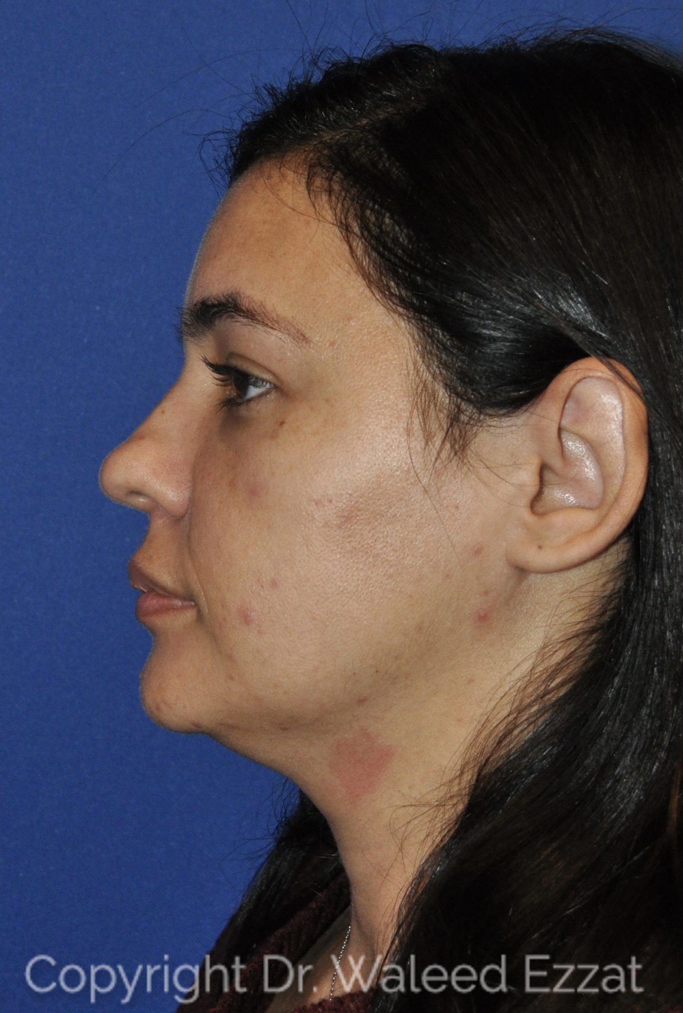 Hispanic/South American Rhinoplasty Patient Photo - Case 22 - before view-0