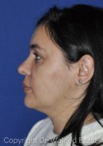 Hispanic/South American Rhinoplasty - Case 22 - After