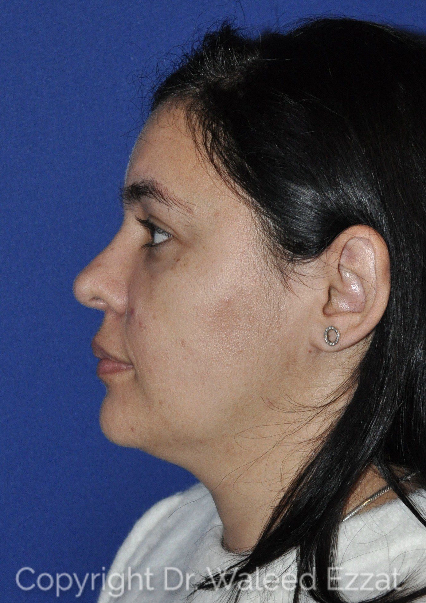 Hispanic/South American Rhinoplasty Patient Photo - Case 22 - after view
