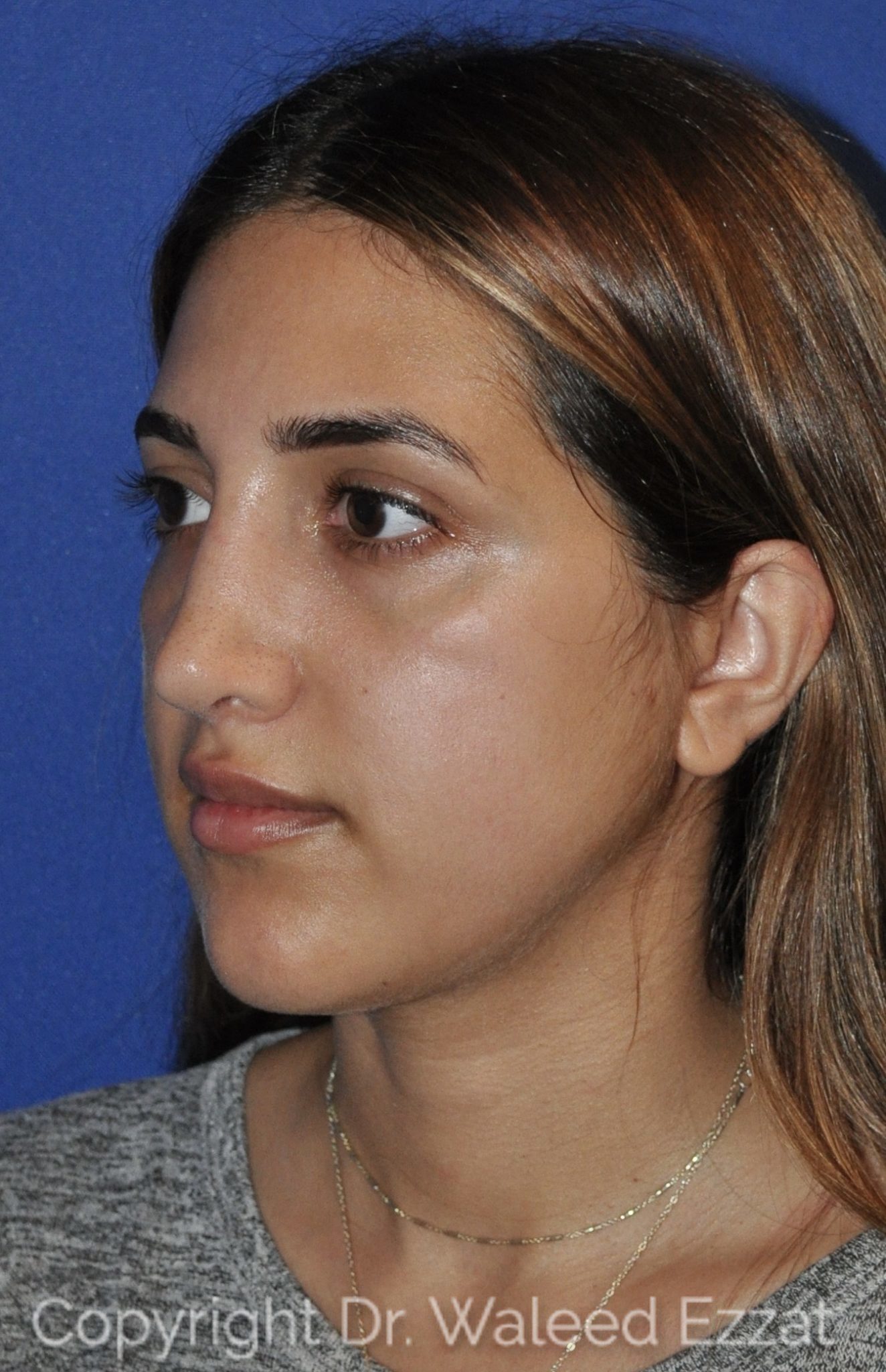 Mediterranean/Middle Eastern Rhinoplasty Patient Photo - Case 114 - after view-1