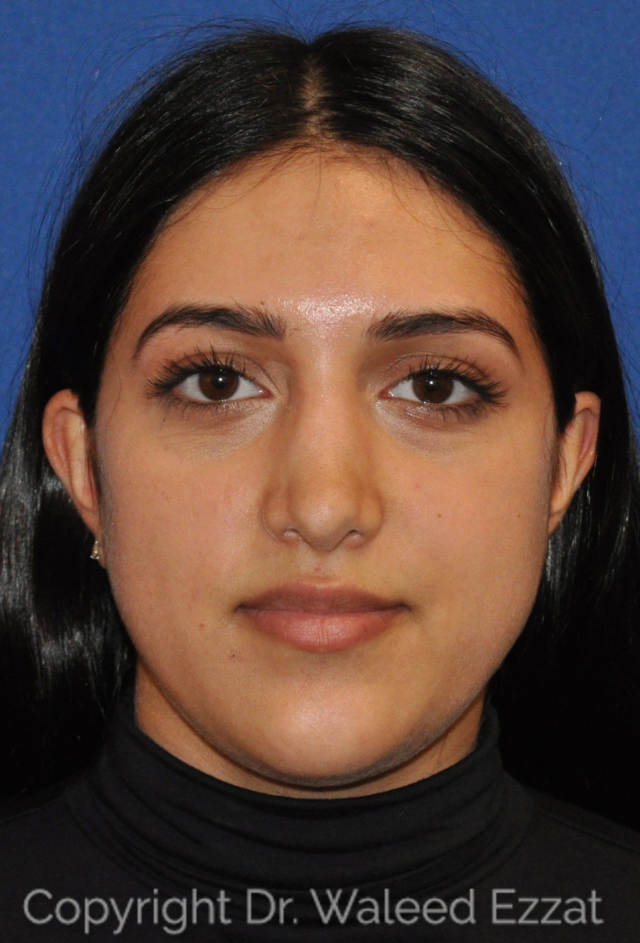 Mediterranean/Middle Eastern Rhinoplasty Patient Photo - Case 114 - before view-2