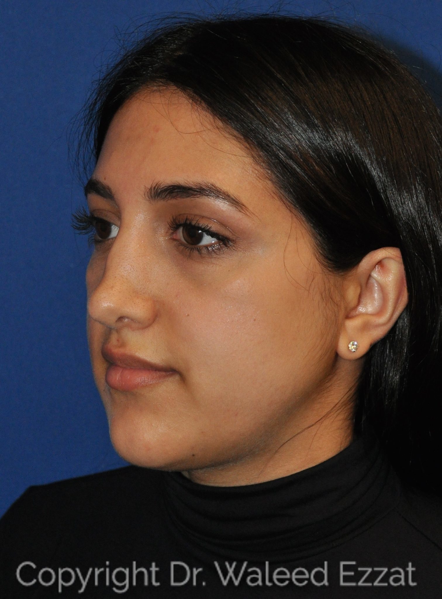 Mediterranean/Middle Eastern Rhinoplasty Patient Photo - Case 114 - before view-1