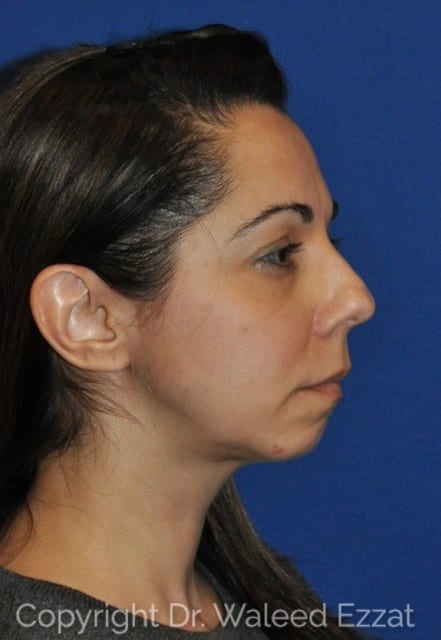 Mediterranean/Middle Eastern Rhinoplasty Patient Photo - Case 44-3 - before view-
