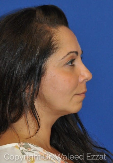Mediterranean/Middle Eastern Rhinoplasty Patient Photo - Case 44-3 - after view
