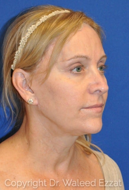 Blepharoplasty Patient Photo - Case 4-A - after view-2