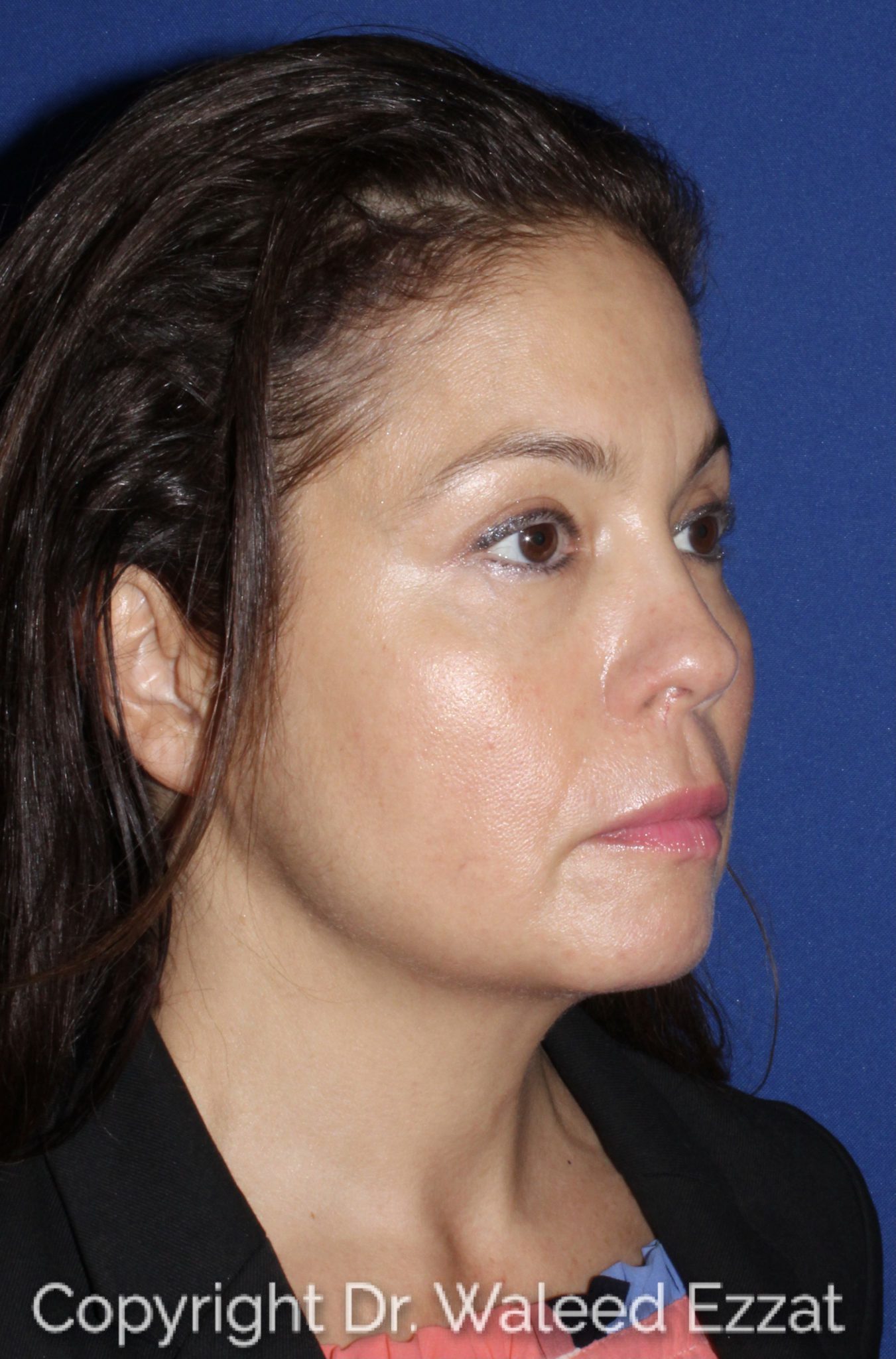 Blepharoplasty Patient Photo - Case 1301 - after view-1