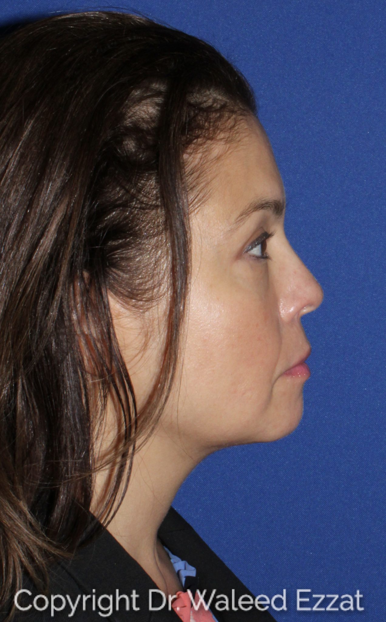 Blepharoplasty Patient Photo - Case 1301 - after view-2