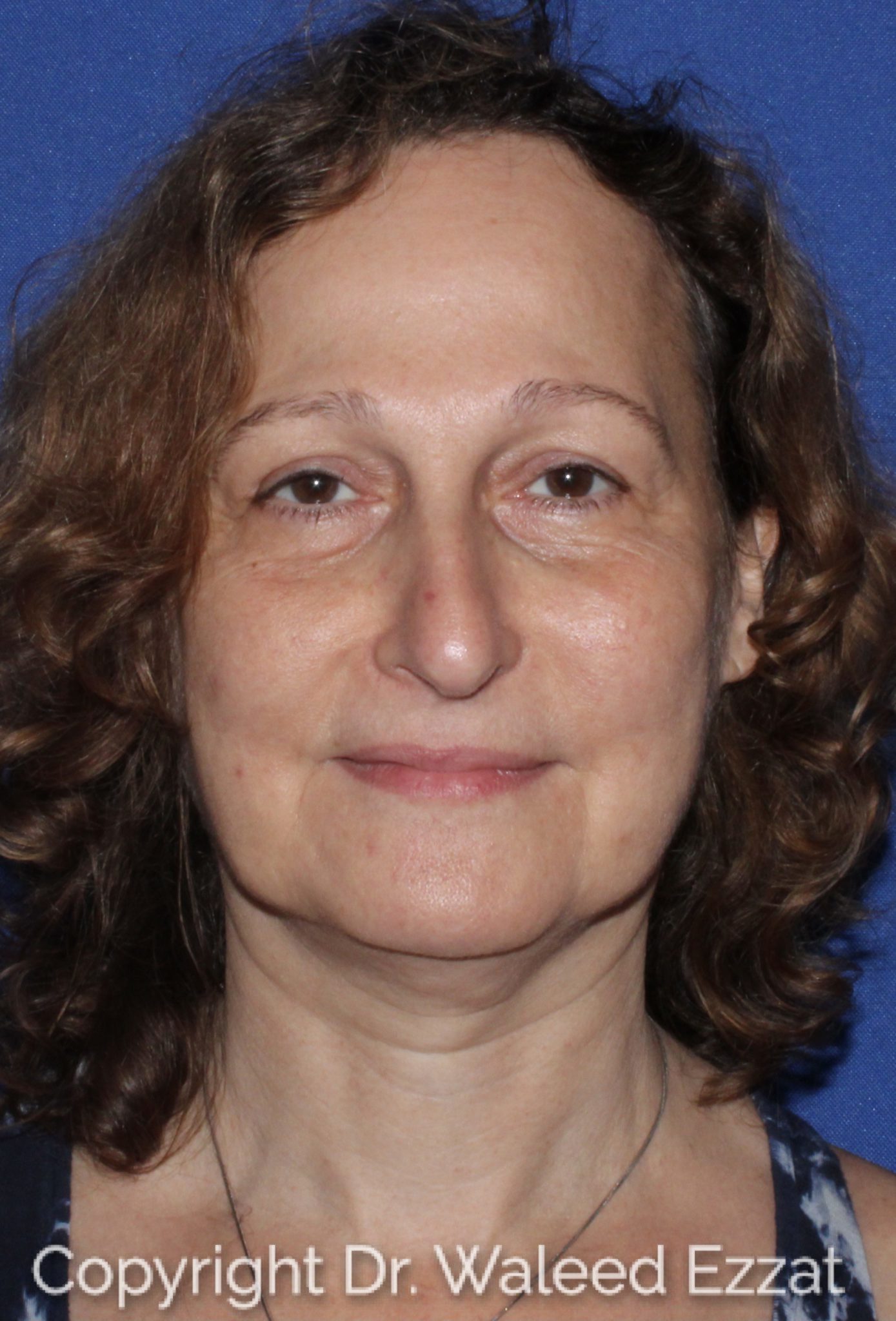 Blepharoplasty Patient Photo - Case 4716 - after view