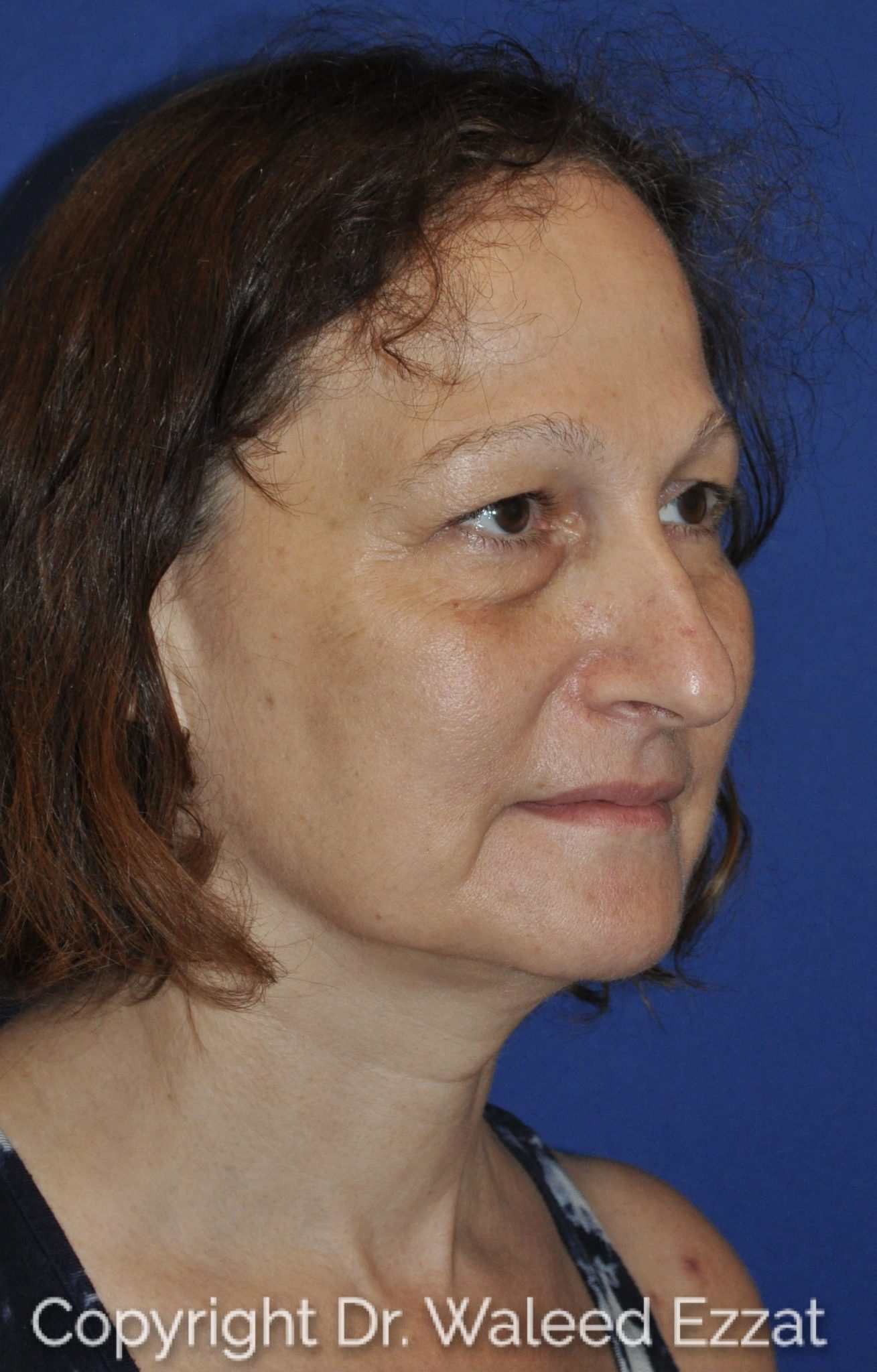 Blepharoplasty Patient Photo - Case 4716 - before view-1