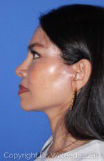 East Asian Rhinoplasty - Case 61 - After