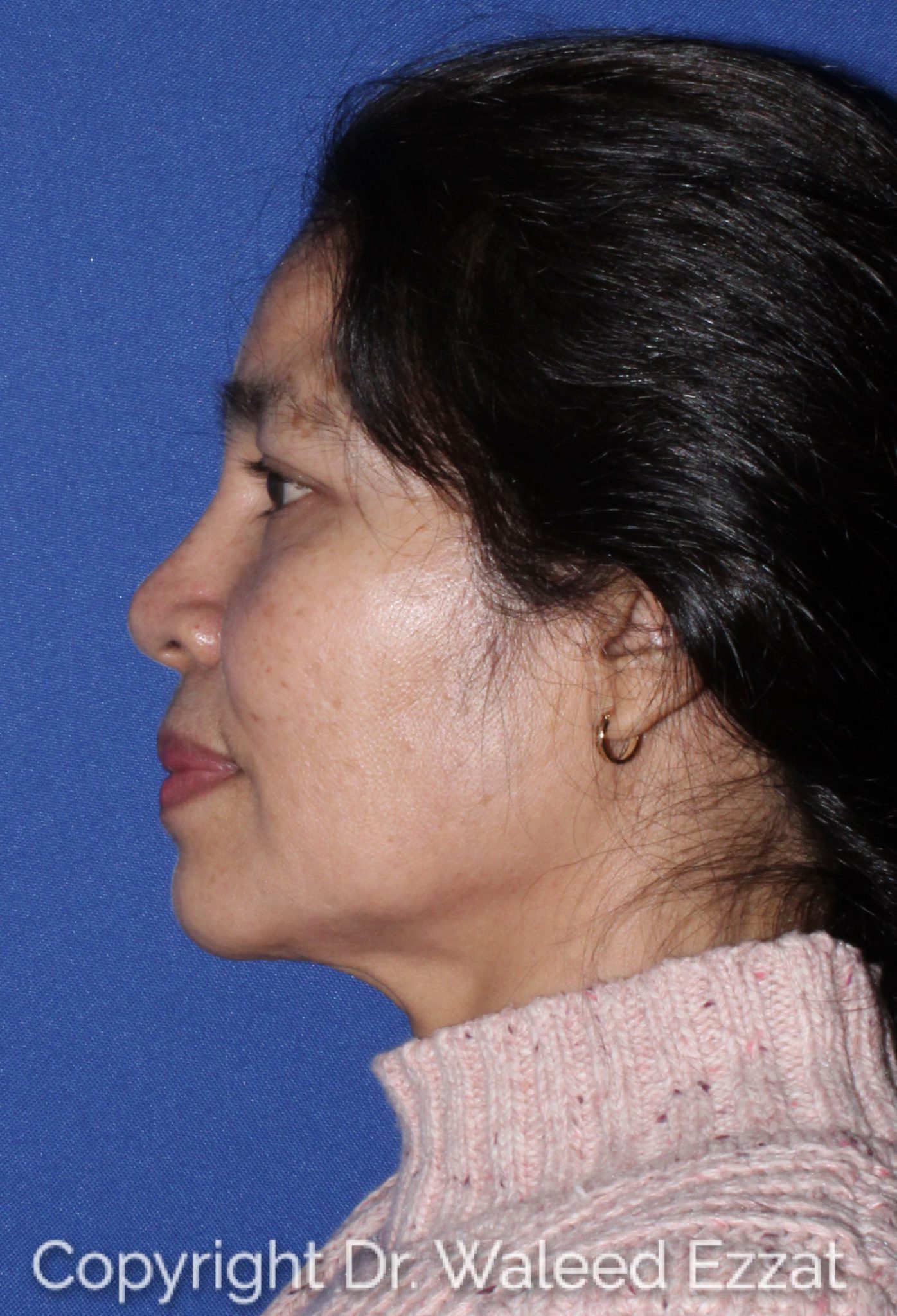 East Asian Rhinoplasty Patient Photo - Case 61 - before view-