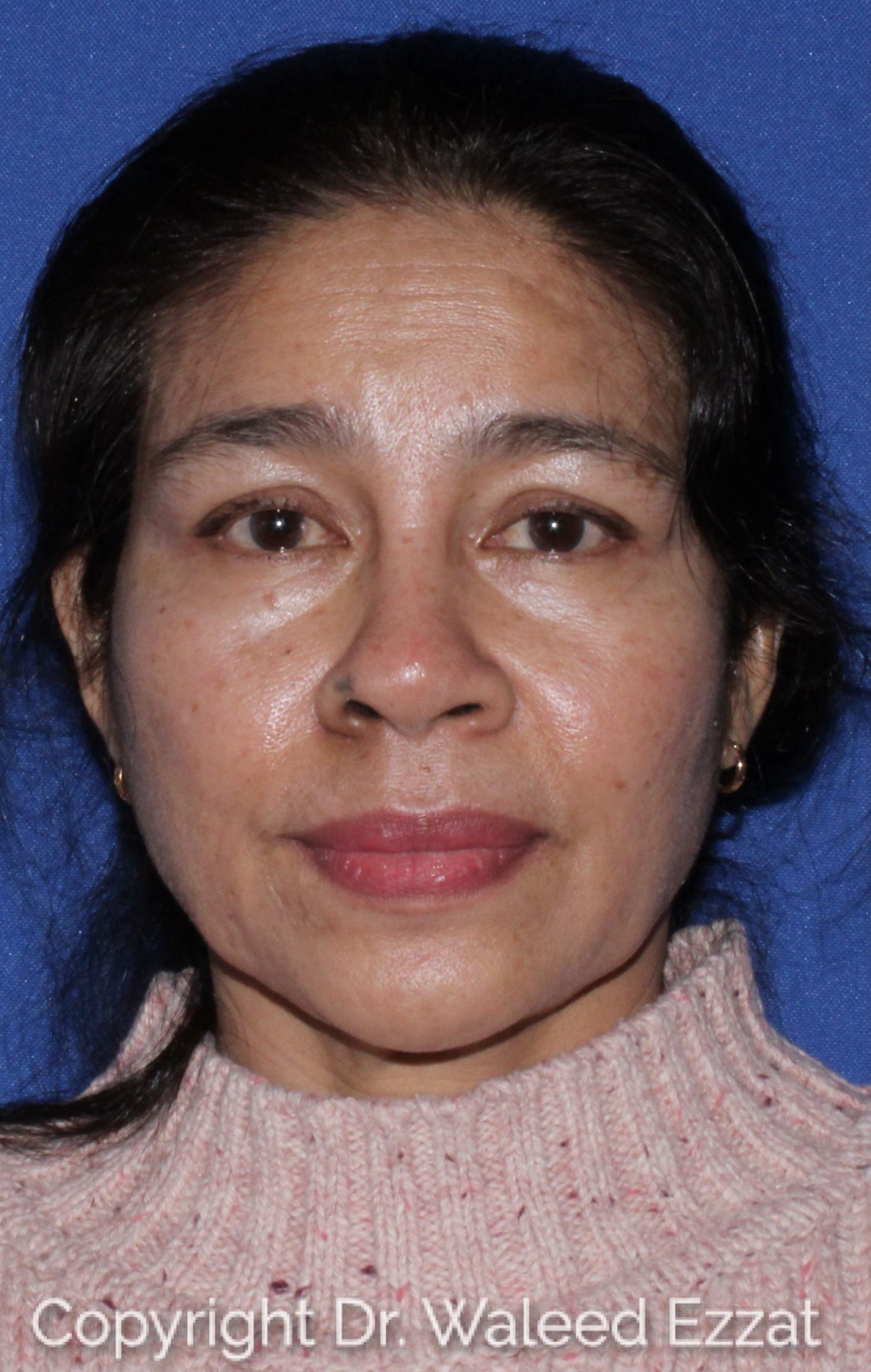 East Asian Rhinoplasty Patient Photo - Case 61 - before view-2
